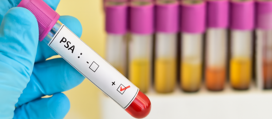 Meu PSA está alto_ o que pode ser e o que fazer_